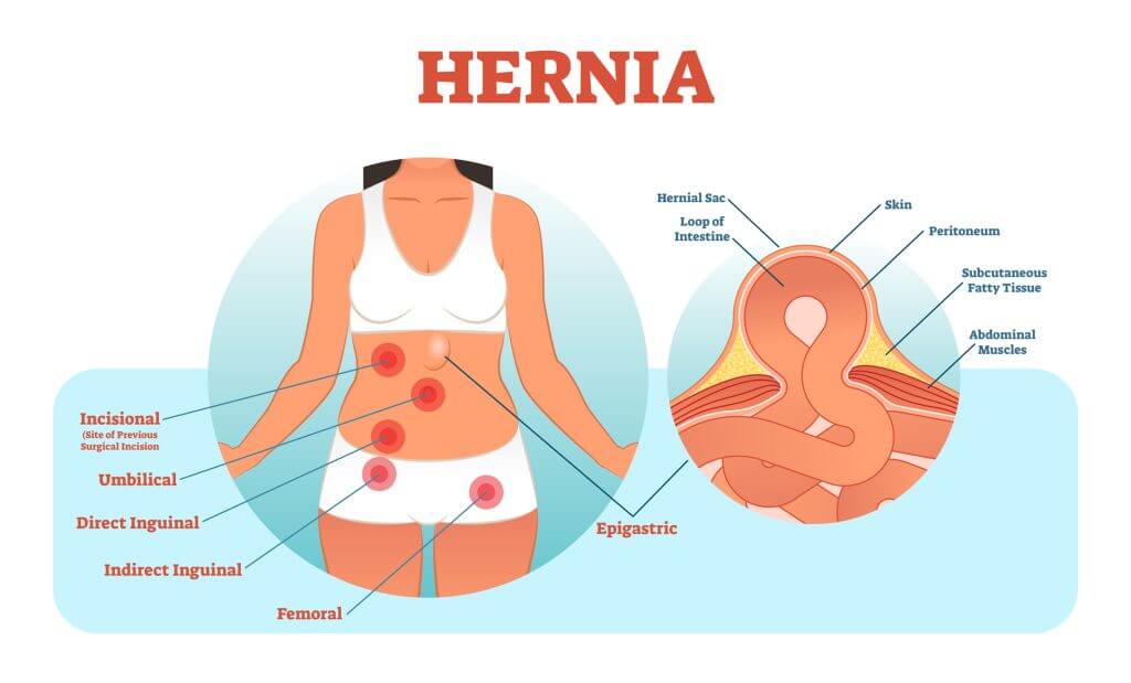 hernia types and locations